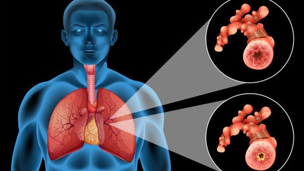 Ani Başlayan Nefes Darlığı, 15-30 Yaş Arası Erkeklerde Daha Yüksek Risk Taşıyor