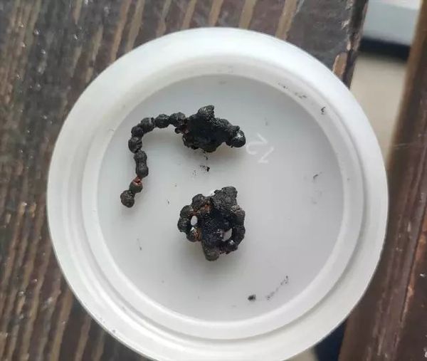 Rize'de 5 Yaşındaki Çocuğun Burnundaki Metal Zincir Başarıyla Çıkarıldı