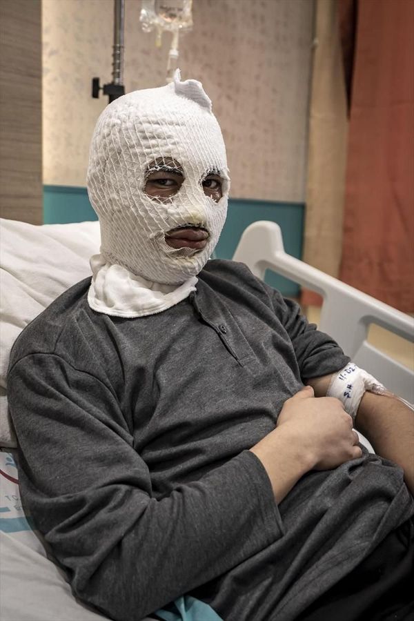 Erzurum'da Çakmak Gazı Tüpü Patladı: Genç Yüzü ve Göğsündeki Yanıklarla Hastanede