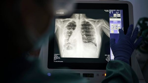 Avrupa’da Tüberküloz Vakalarının Beşte Biri Tanılamıyor, İlaç Direnci Yüksek