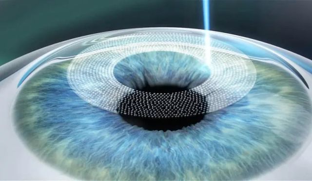 SMILE Cerrahisinde Sağlam Kornea Üzerinde İlk Doğrudan İlaç Penetrasyonu Ölçümü