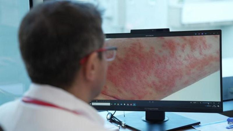 Uzmanlar Uyarıyor: Egzamalı Çocuklara Rastgele Diyet Uygulanmamalı