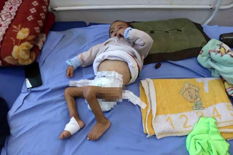 Gazze'de Çocuklar Yetersiz Beslenme ve Açlıkla Mücadele Ediyor