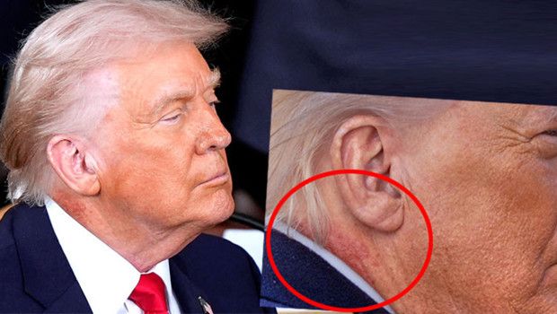 Trump’ın Boynundaki Kızarıklık İçin Koruyucu Krem Tedavisi Uygulanıyor