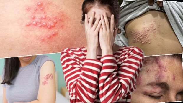 Zona Hastalığı Gençlerde Artıyor: Şiddetli Ağrılar ve Uzun Süren Etkiler Yaşanıyor