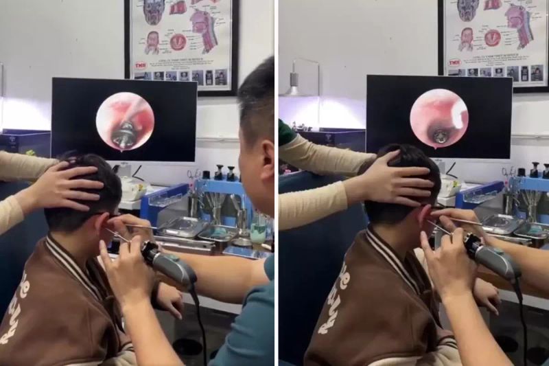 Vietnam'da Küçük Çocuğun Kulak Ağrısına Metal Vida Neden Oldu