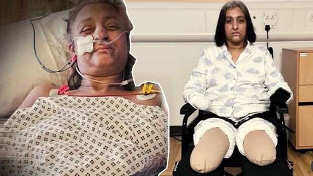 Köpek Isırığı Sonrası Gelişen Sepsis, Manjit Sangha'nın Ellerini ve Ayaklarını Kaybetmesine Yol Açtı