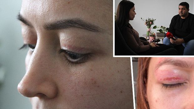 Güzellik salonunda yapılan 1.100 TL'lik plazma pen işlemi genç kadının göz sağlığını etkiledi