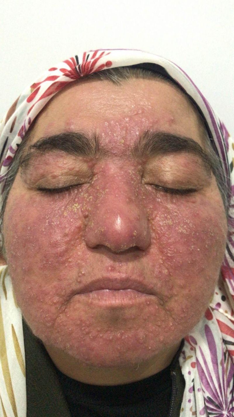 Yozgatlı Kadın 20 Yıllık Cilt Hastalığını Başarıyla Yendi, Sosyal Hayata Döndü