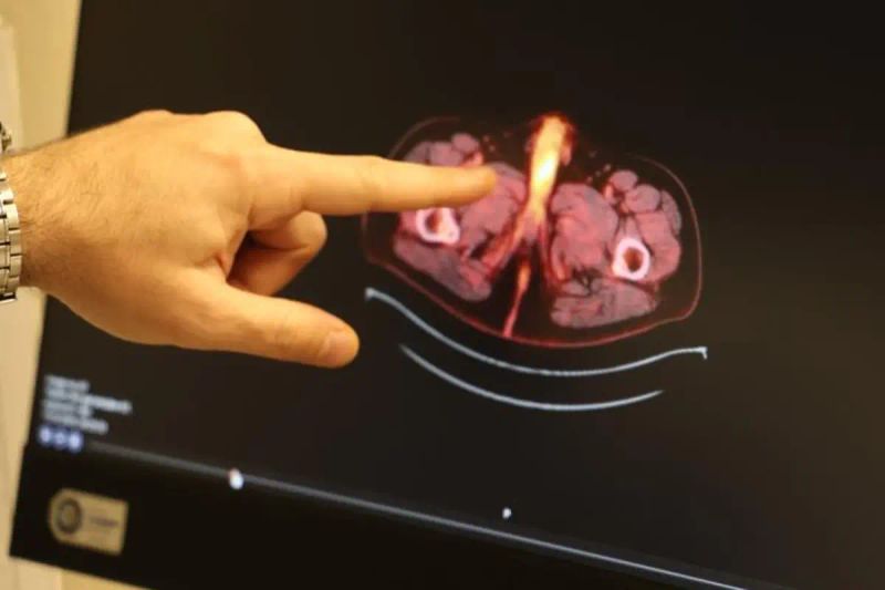 Diyarbakır'da Nadir Bir Kolon Kanseri Vakası: Penis Ameliyatıyla Hayat Kalitesi Arttı